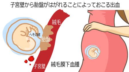 胎盤形成出血|妊娠初期の出血について、原因・対処法を解説！